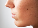 What you should know about moles and melanoma